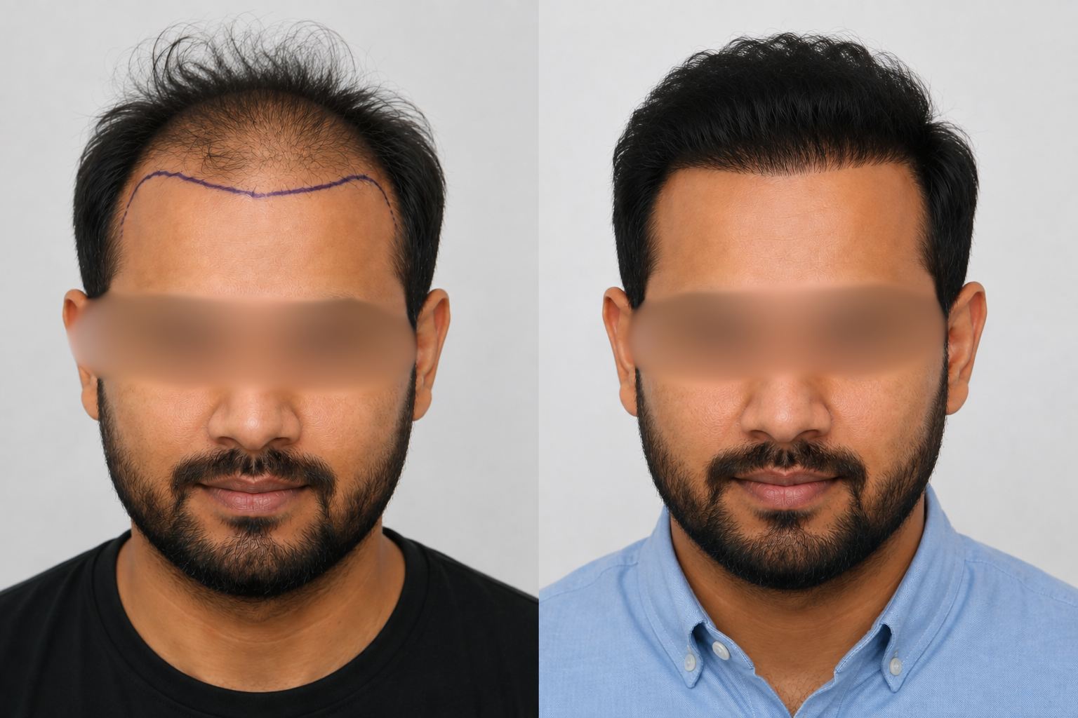 FUE Hairline Restoration